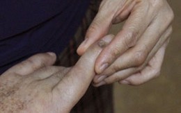 Cách phòng, chữa bệnh chín mé