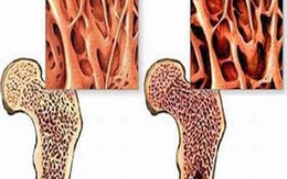 Bệnh nhân ung thư giai đoạn cuối bỗng… hồi sinh