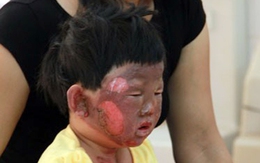 Đổ xăng, 5 người trong một gia đình phỏng nặng