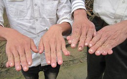 Hàng trăm trẻ dính tay, thừa ngón kỳ lạ