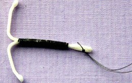 Tránh thai sau 5 ngày “quan hệ”