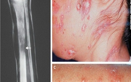 Xác định bệnh lạ giống bệnh AIDS ở Châu Á