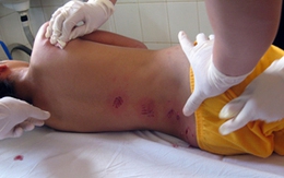 Bé gái bị chó becgiê cắn khắp người