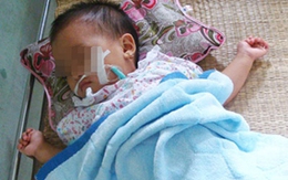Nhai dây điện, bé 12 tháng tuổi hôn mê, teo não