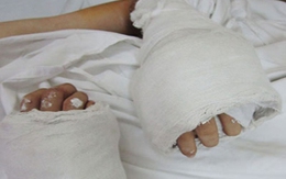 Nối thành công hai bàn tay đứt lìa