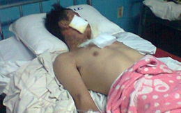 Hai sinh viên bỏng nặng vì nướng mực bằng cồn