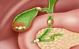 Dự phòng tái phát sỏi mật 