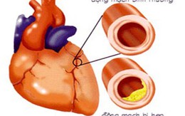 Đau tim, đau thắt ngực – Dấu hiệu nguy hiểm!