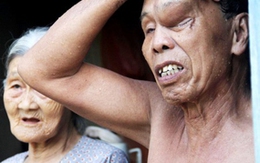 Khốn khổ vì mọc “sừng” trên trán