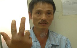 Hà Nội: Bệnh nhân nhập viện vì chuột cắn