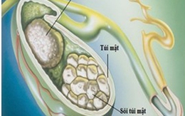 Sỏi mật – nguyên nhân chính gây nhiễm khuẩn gan mật 