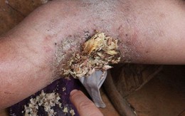 Bé gái 3 năm sống với chân có giòi