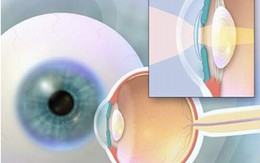 Phát hiện, phòng ngừa và điều trị một số bệnh lý về mắt do lão hóa