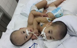 2 em bé dính liền tim, gan ở Sài Gòn đã được tách rời thành công