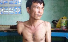 Kinh hoàng người đàn ông bị rụng dần chân tay