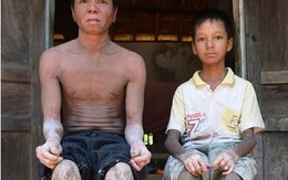 Xót thương hai cha con 'người rắn'