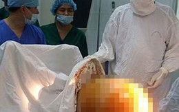 Con dâu mang khối u khủng 23kg: Mẹ chồng hụt hẫng