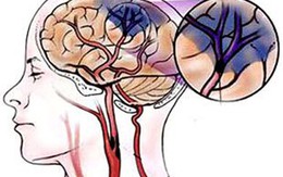 Những thói quen xấu dễ gây thiếu máu não