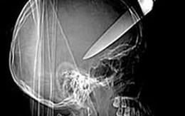 Thoát chết sau khi bị dao đâm xuyên đầu