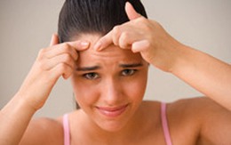 Để mụn không làm giảm vẻ đẹp của bạn