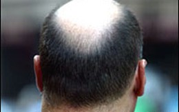 Quảng cáo trên… đầu hói