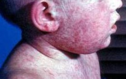 Khi nào cần tiêm vaccin sởi?
