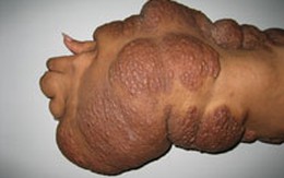 Biến “tay gấu” thành tay người