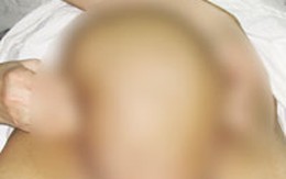 1.900 ngày khổ ải với khối u khổng lồ ở "vùng kín"