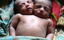 Thêm một bé trai sơ sinh 2 đầu ra đời