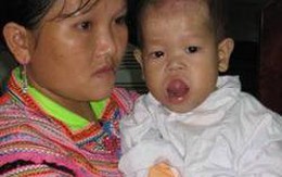 Cháu bé có khối u lưỡi khổng lồ được ra viện