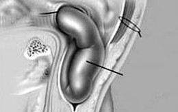 Thoát vị bẹn hay gặp ở trẻ sinh thiếu tháng