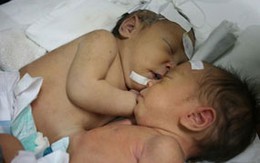 Song thai dễ mắc dị tật