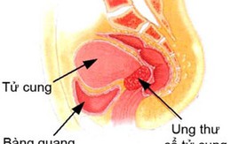 Chính thức chỉnh sửa độ tuổi tiêm vắc-xin ung thư cổ tử cung