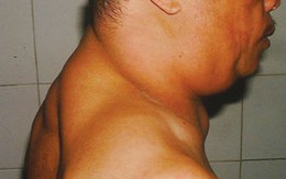 Nghiện rượu dễ bị u mỡ