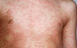 Cách nhận biết và phòng ngừa bệnh sởi