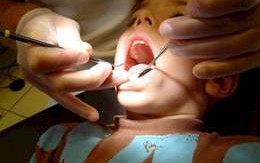 Tư vấn sức khỏe: Sâu răng có ảnh hưởng đến sức khỏe trẻ?