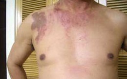 Hà Nội: Một luật sư bị tạt axit