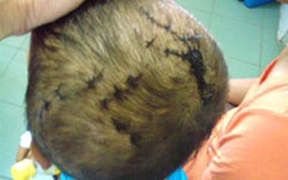 Chó vồ, một trẻ nhỏ phải khâu 35 mũi 