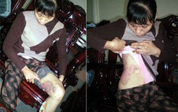 Vụ Chồng dội nồi canh đang sôi lên người vợ: Nỗi bi phẫn tột cùng của người vợ