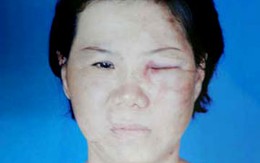 Một phụ nữ bị hành hạ dã man