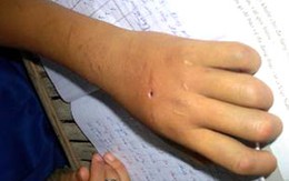 Nghi trộm vàng, một bé gái bị tra tấn dã man