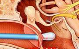 Triệu chứng của bệnh thủng màng nhĩ