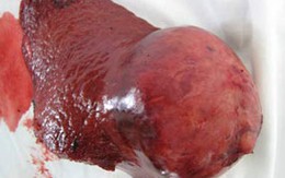 Quảng Nam: Cắt bỏ khối u gan "siêu lớn" của một bệnh nhân 