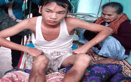 78 tháng tù cho kẻ hành hạ cháu bằng nước sôi