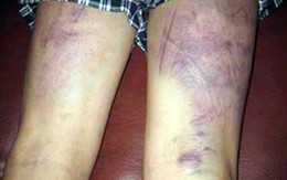 Trưởng công an xã dùng “nghiệp vụ” dã man để tra khảo dân