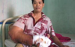 Cánh tay dài 1,2m, nặng 25kg ra viện