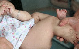 Bé gái 7 tháng tuổi có 2 bàn chân phải