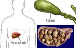 Đông y trị sỏi mật