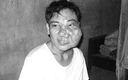 Hãy cứu giúp người đàn ông 36 năm có khối u trên mặt