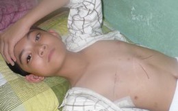 Con bị bệnh lõm ngực, mẹ tưởng suy dinh dưỡng